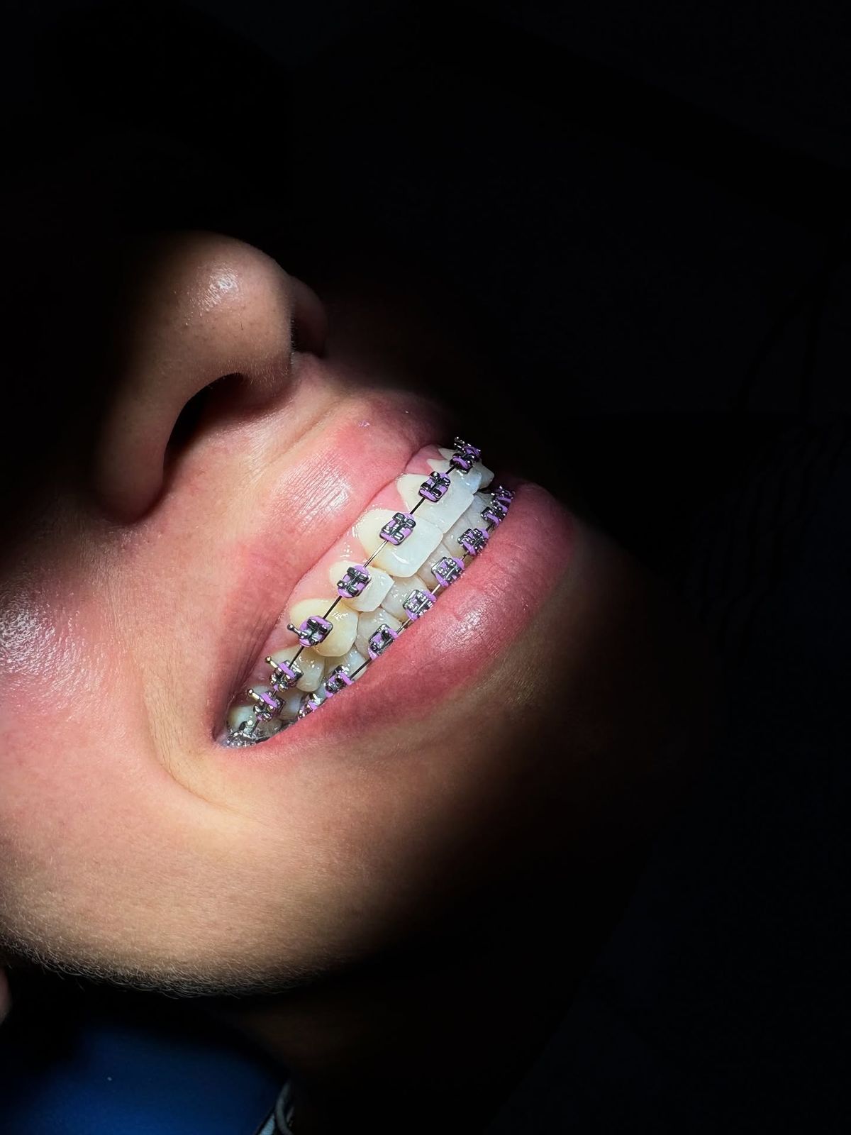 Orthodontie par brackets